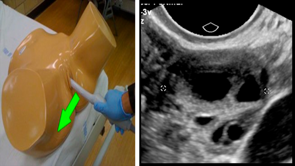 TRANSVAGINAL-OVARIO-IZQUIERDO-CORTE-AXIAL