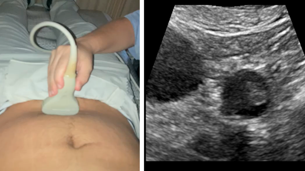 ABORDAJE-PELVICO-OVARIO-IZQUIERDO-CORTE-AXIAL