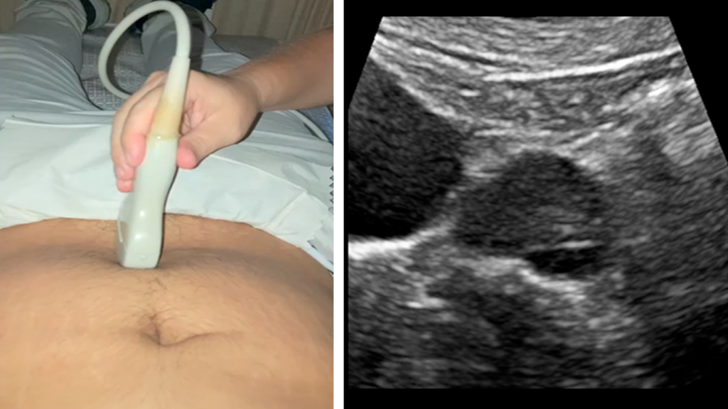 ABORDAJE-PELVICO-OVARIO-IZQUIERDO-CORTE-SAGITAL