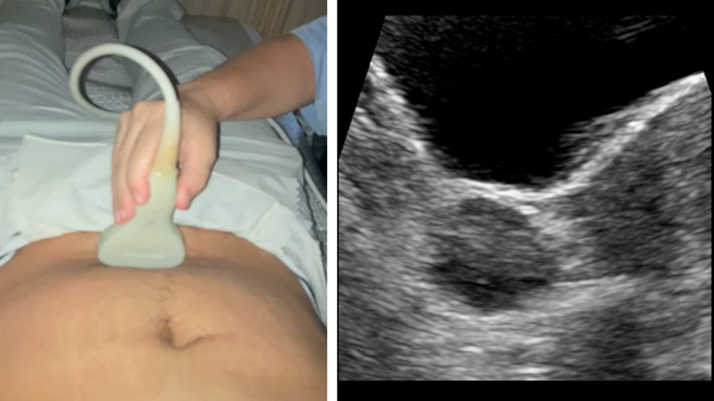 CORTE-AXIAL-OVARIO-DERECHO-ABORDAJE-PELVICO