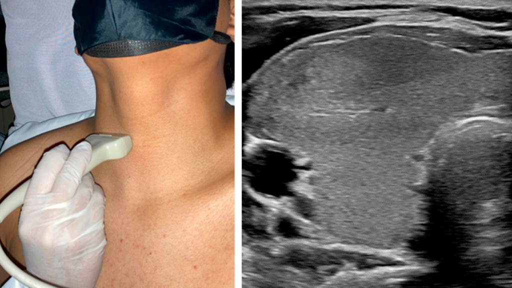LOBULO-TD-CORTE-AXIAL-TIROIDES