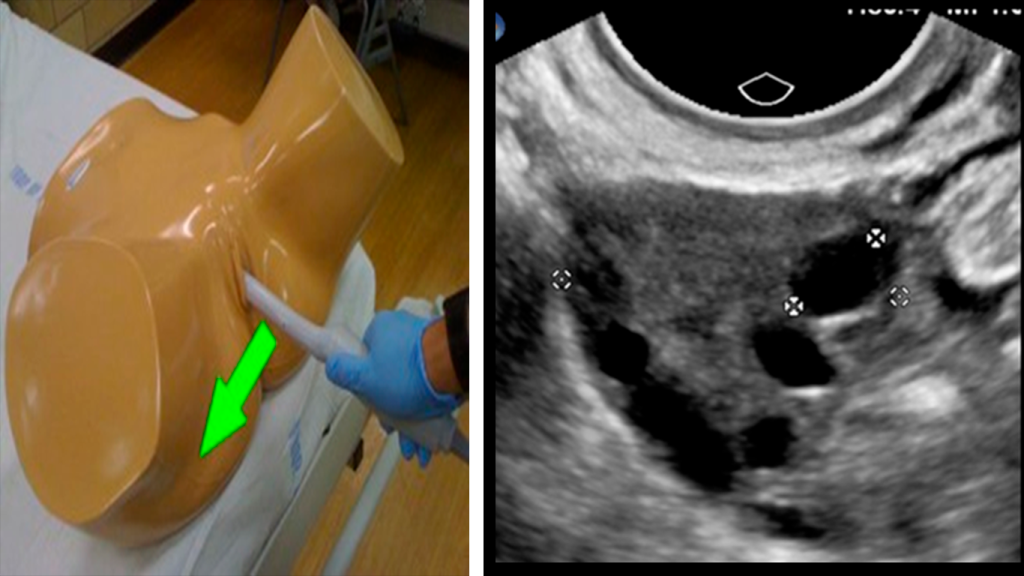 TRANSVAGINAL-OVARIO-DERECHO-CORTE-AXIAL