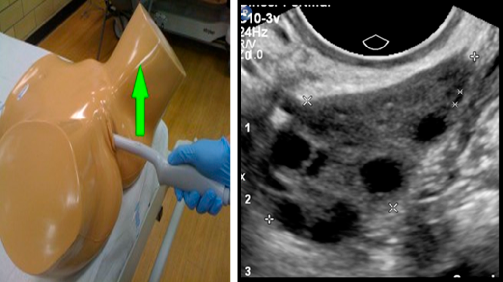 TRANSVAGINAL-OVARIO-DERECHO---CORTE-SAGITAL-