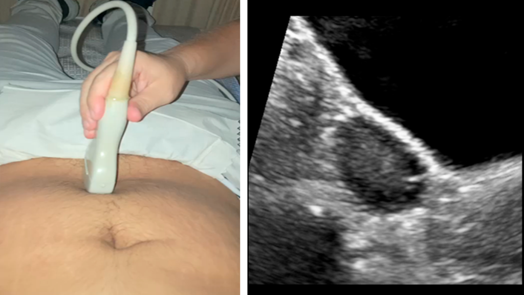 abordaje-pelvico-corte-sagital-ovario-derecho
